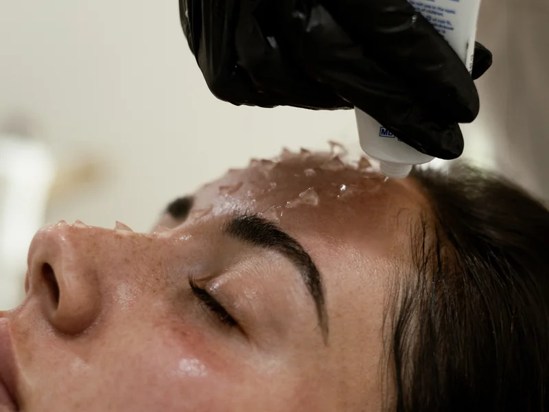 Chemical peel treatment